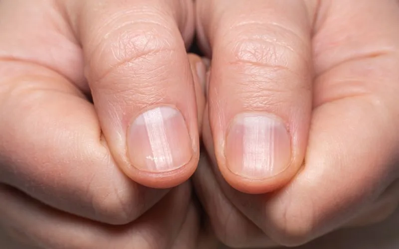 nail prob