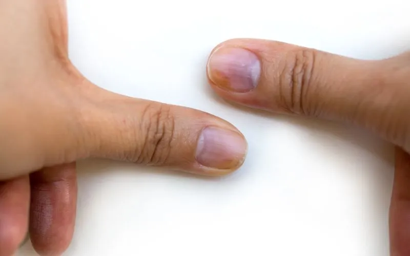 nail discoloration