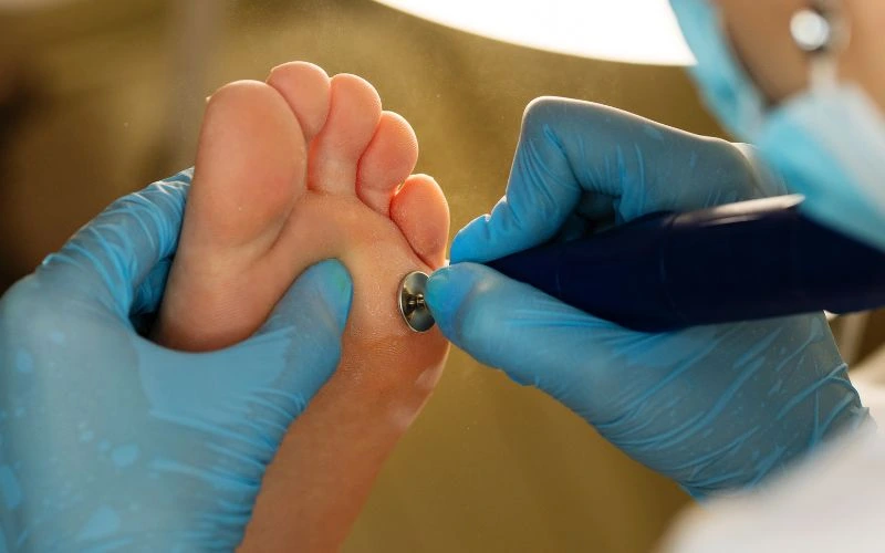 Professional Help for Callus Treatment