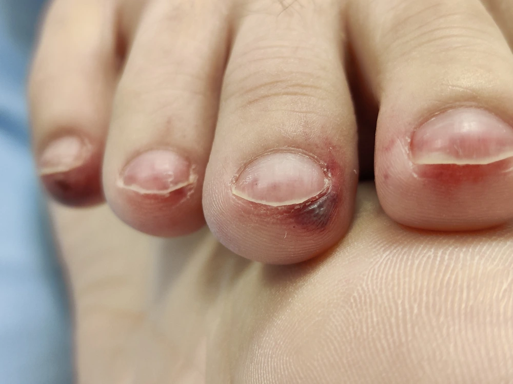 Health Conditions Causing Purple Nails