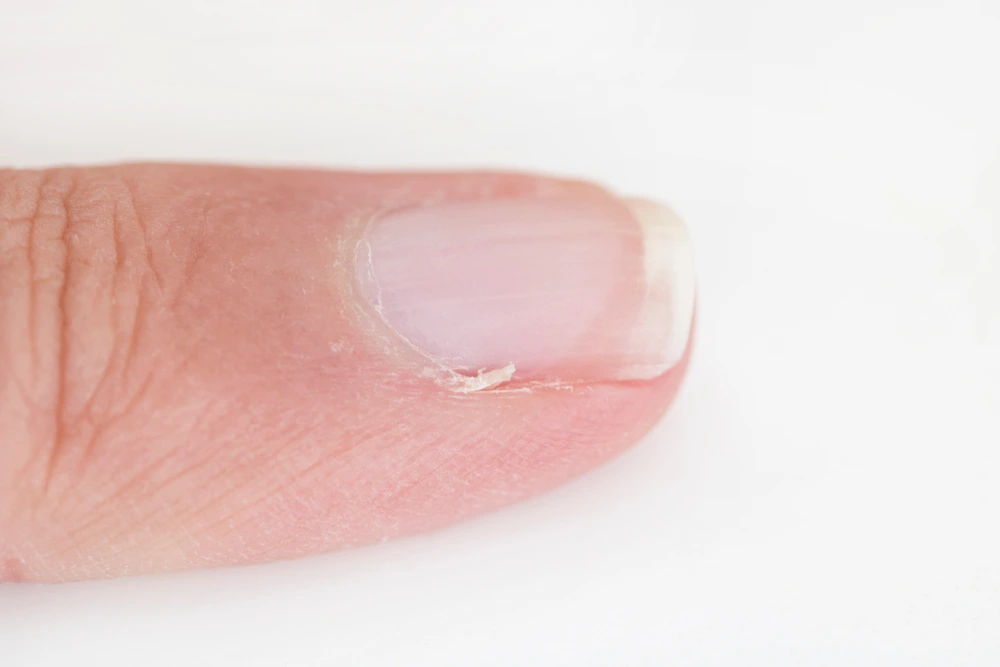 Symptoms of Dry Cuticles and Hangnails