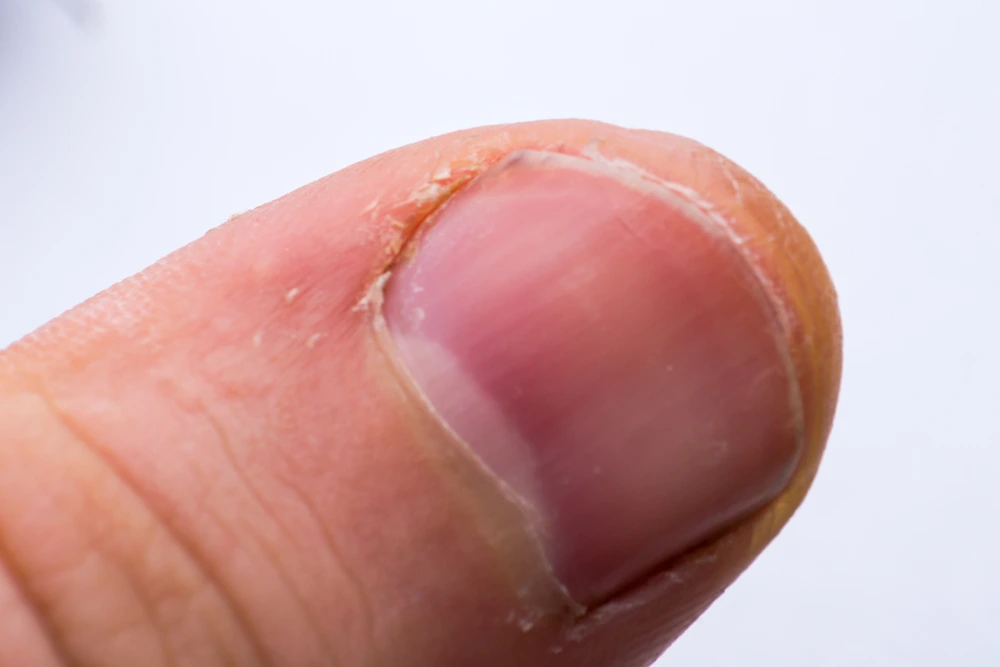 When to Seek Medical Help for Dry Cuticles and Hangnails