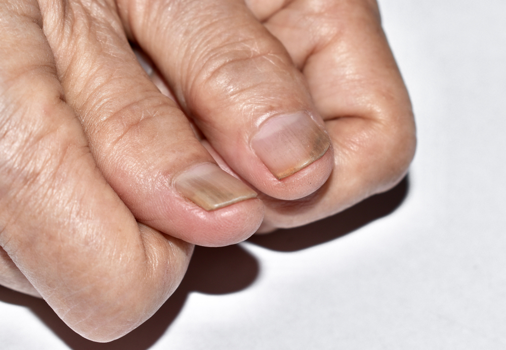 Subungual Melanoma vs Hematoma