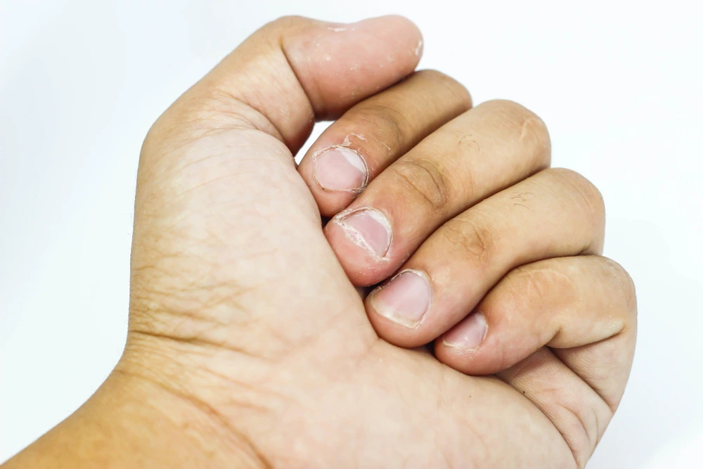Signs of Nail Fungus