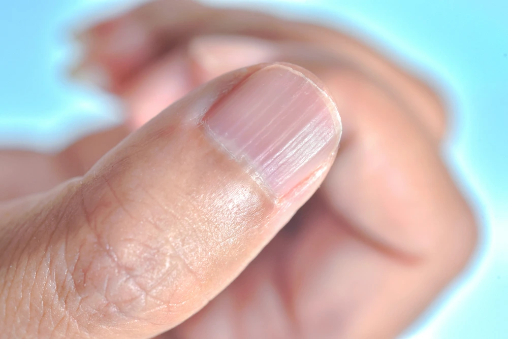 Nail Abnormalities