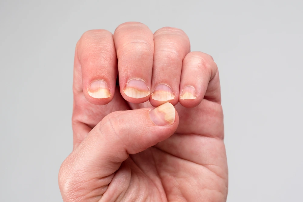 Causes of Nail Disorders