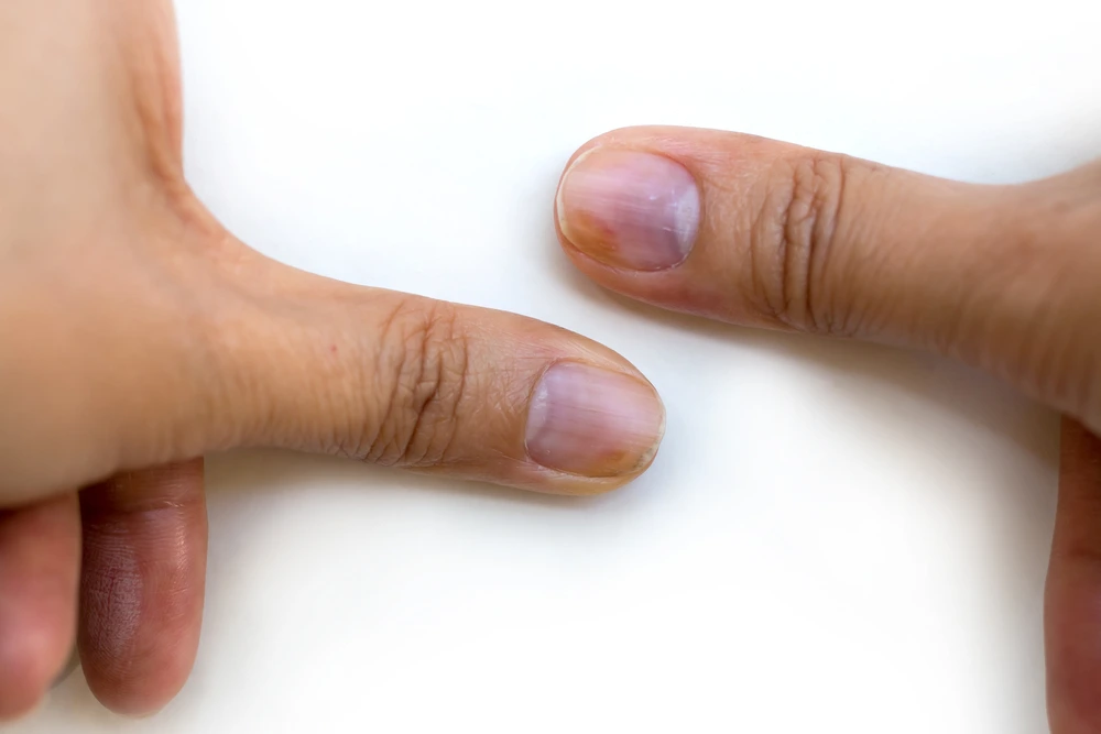 Common Nail Problems