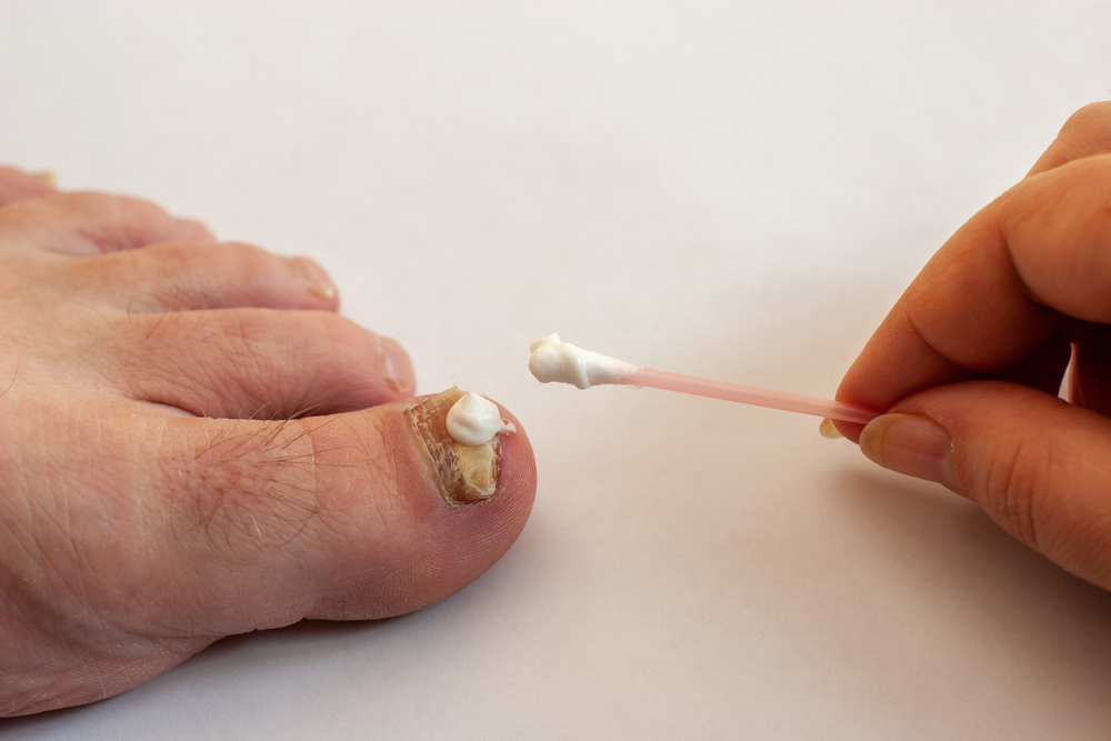 Using Bleach for Toenail Fungus