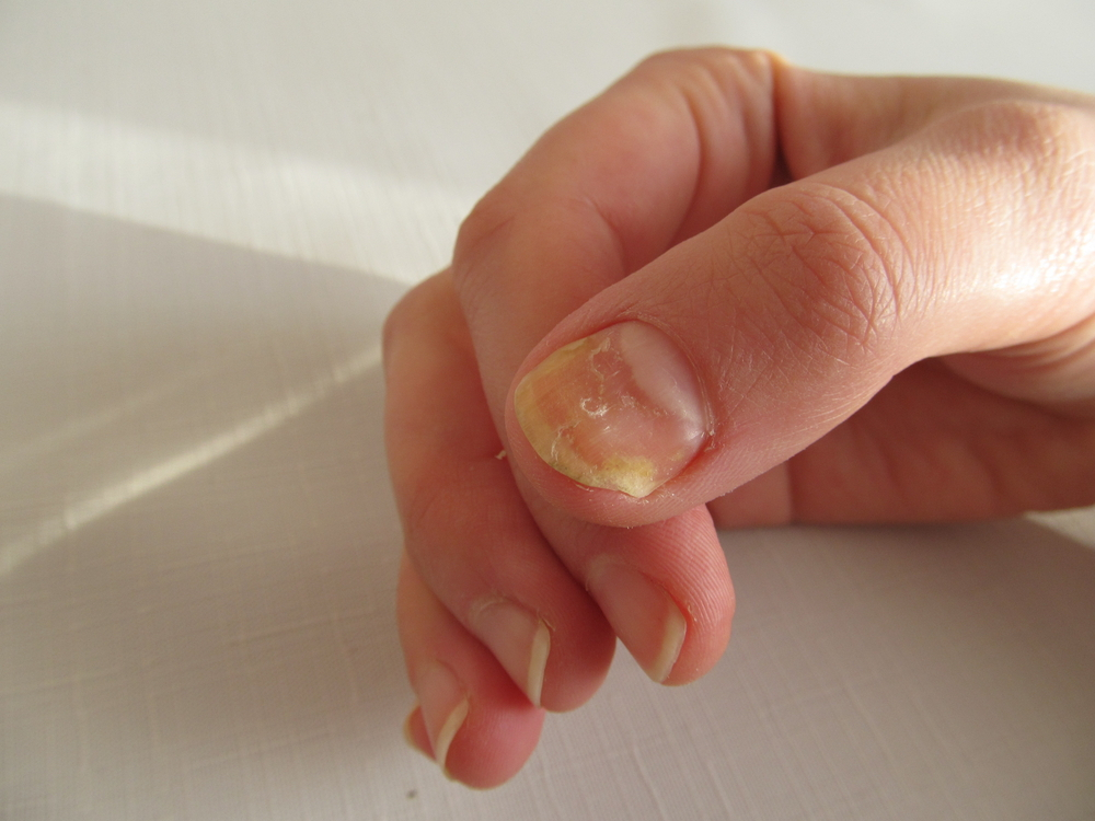 Risks of Getting Fingernail Fungus at Nail Salons